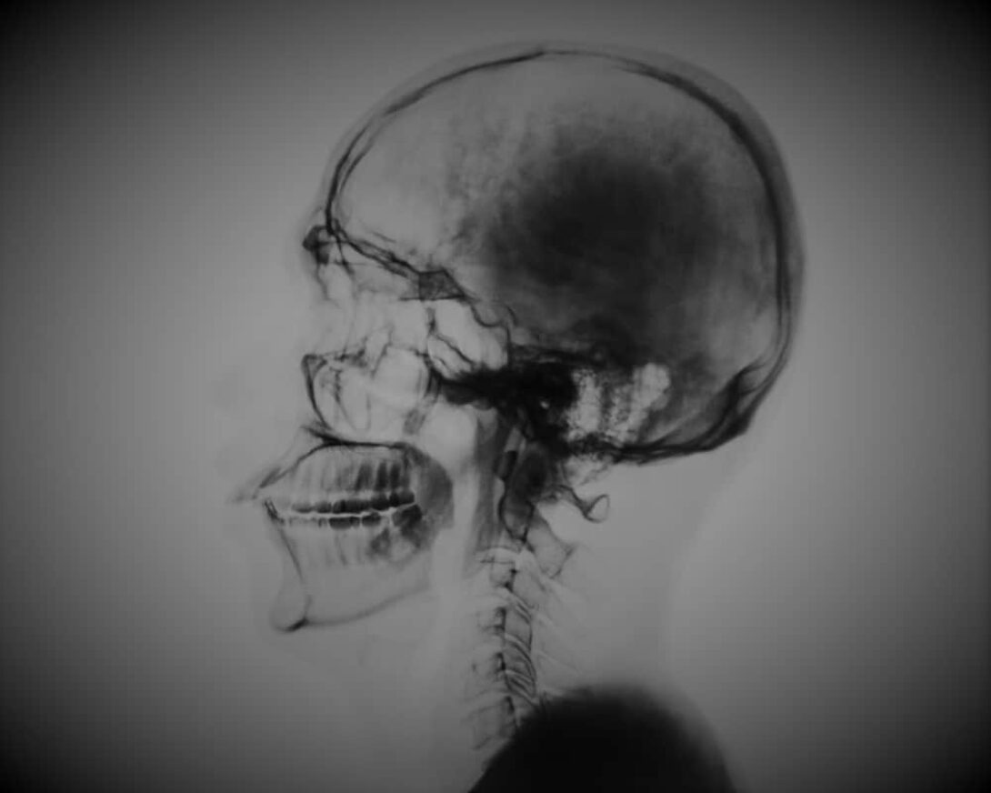 Remain brain
